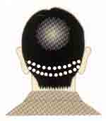 NHT式自毛植毛手術の方法