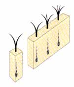 NHT式自毛植毛手術の方法