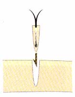 NHT式自毛植毛手術の方法