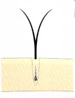 NHT式自毛植毛手術の方法