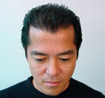 自毛植毛手術後体験体験者画像1