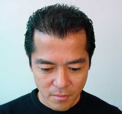 自毛植毛体験者の手術後画像