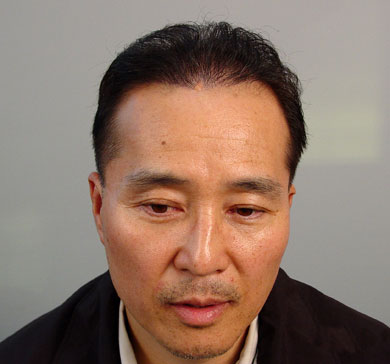 自毛植毛体験者の手術後画像