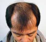 自毛植毛手術前体験者画像1