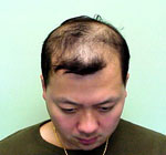 自毛植毛手術前体験者画像2