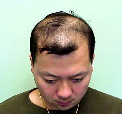 自毛植毛体験者の手術前画像