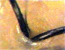 育毛ヘアケアコース、頭皮の脂取り後の画像